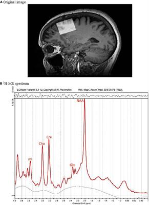 Does Prefrontal Glutamate Index Cognitive Changes in Parkinson’s Disease?